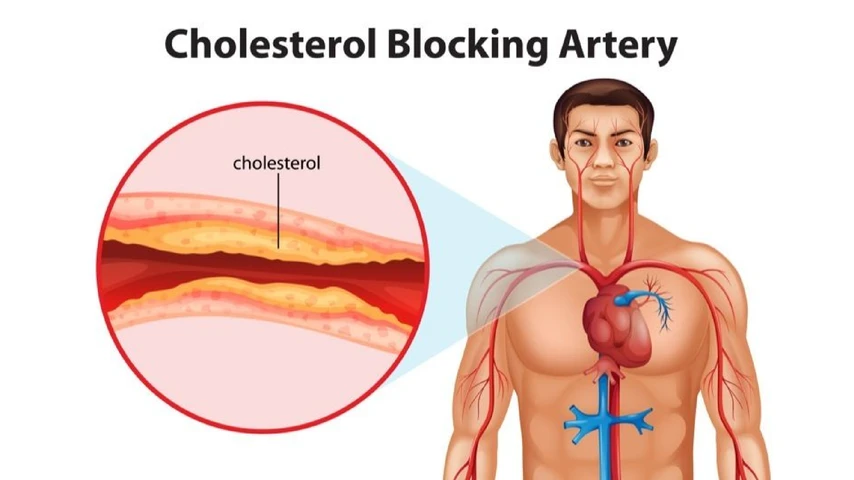 Cholesterol blocking artery man